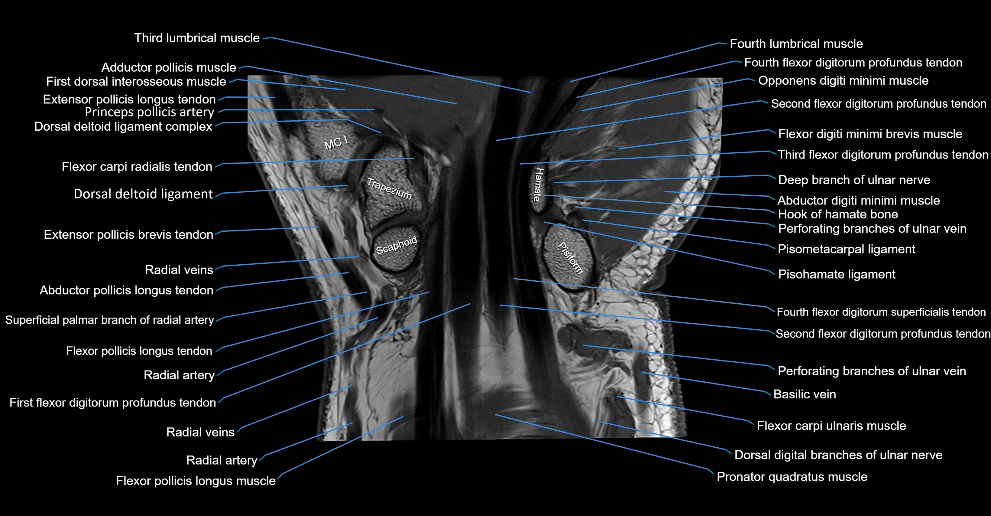 MRI wrist coronal cross sectional anatomy 3T  radiology  image-img-00001-00018.webp